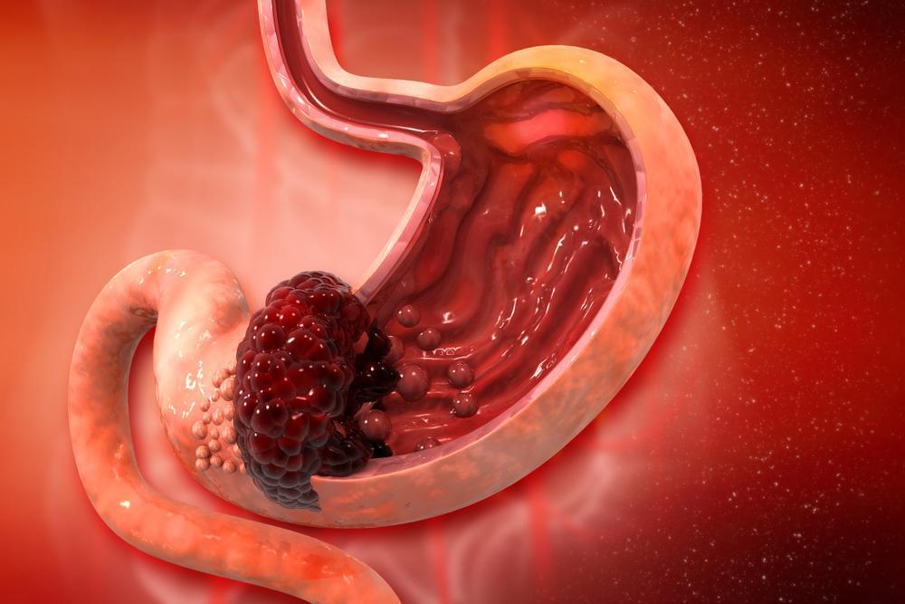 HIỂU ĐÚNG VỀ UNG THƯ
Để bảo vệ chính mình và cả gia đình